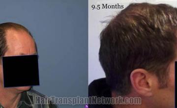 Right view before and after hair restoration procedure