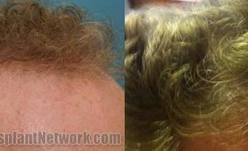 Hair restoration procedure before and after results