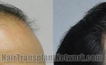 Hair restoration procedure before and after results