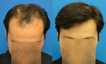 Hair restoration procedure before and after pictures