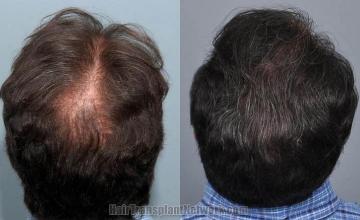 Hair transplantation surgery before and after images