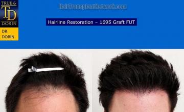 Hair restoration procedure before and after results