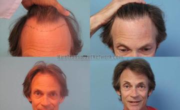 Before and after hair transplant procedure images