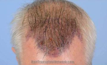 Hair transplant surgery before and after photos