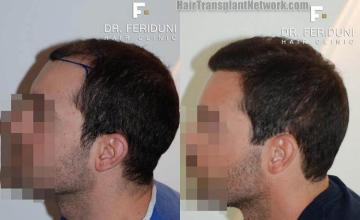 Hair transplantation surgery before and after photos