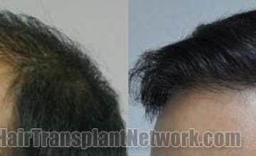 Hair transplantation surgery before and after photos