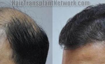 Hair restoration procedure before and after pictures