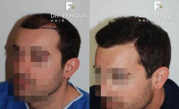 Hair restoration procedure before and after pictures