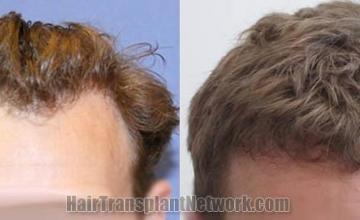 Hair restoration procedure before and after results