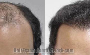 Hair restoration procedure before and after results