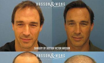 Front view - Before and after hair restoration procedure