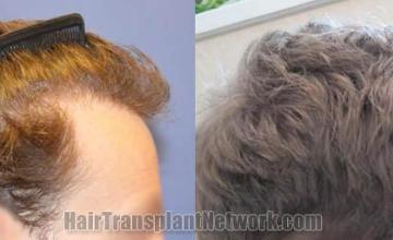 Hair transplantation surgery before and after photos