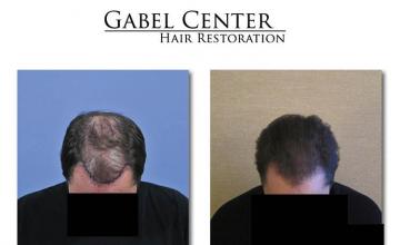 Hair transplantation surgery before and after photos