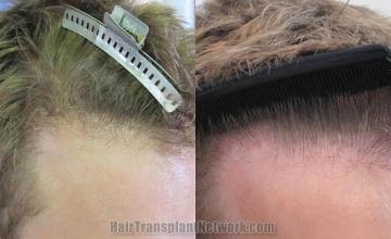 Hair restoration procedure before and after results