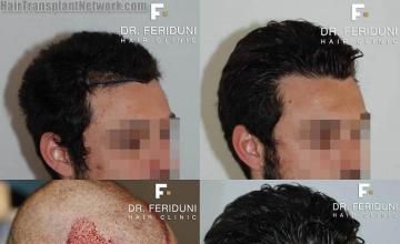 Hair transplantation surgery before and after photos