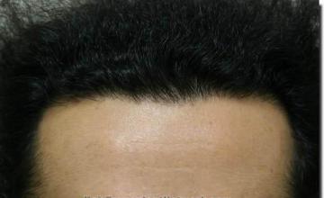 Hair restoration procedure results