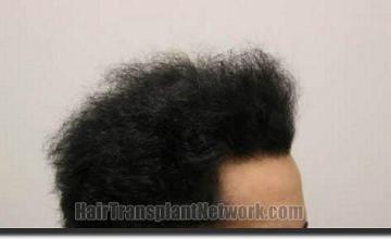 Hair restoration procedure results