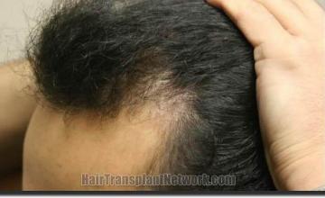 Hair restoration procedure results