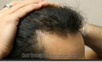 Hair restoration procedure results