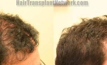 Hair transplantation surgery before and after images