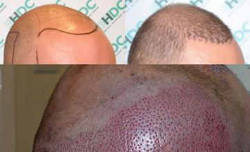 Hair transplantation surgery before and after photos