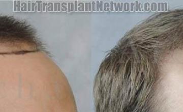 Hair transplantation surgery before and after photos