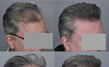 Hair transplantation surgery before and after images