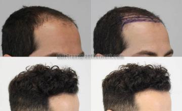 Hair restoration procedure after result images