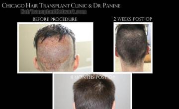 Surgical hair transplantation result photographs