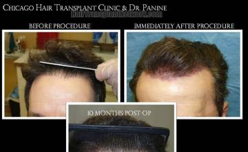 Hair restoration procedure before and after results