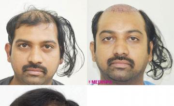 Before and after hair restoration procedure images