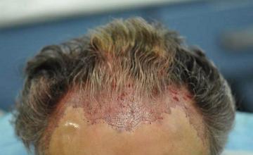 Hair transplant surgery results immediate postoperative