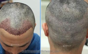 Surgical hair transplantation result photographs