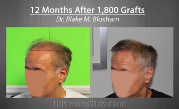 Hair restoration surgery before and after images