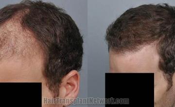 Hair transplantation surgery before and after images