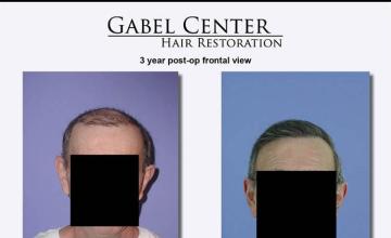 Front view before and after hair transplant results