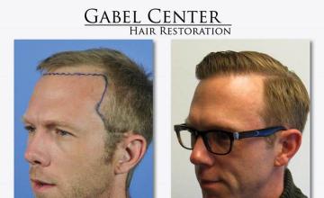 Hair transplantation surgery before and after pictures