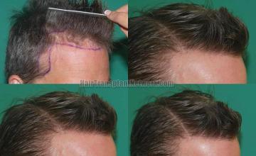 Hair transplantation surgery before and after photos