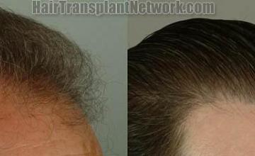 Hair restoration procedure before and after pictures