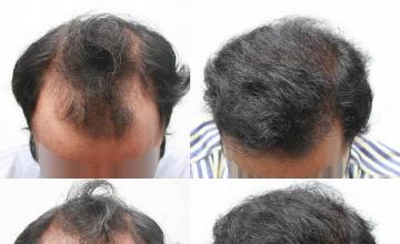 Top view before and after hair restoration results