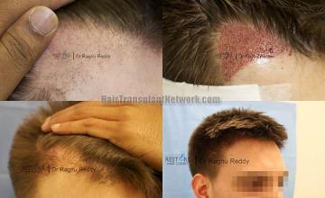 Hair restoration procedure before and after pictures