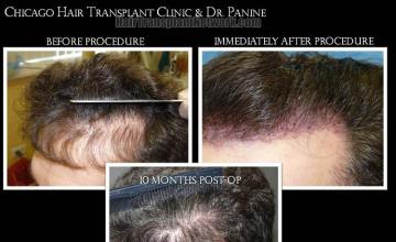 Hair restoration procedure before and after pictures