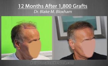 Hair restoration surgery before and after photos