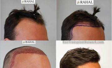 Hair transplantation surgery before and after photos