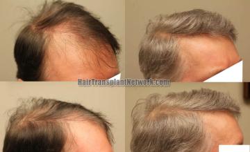 Hair transplantation procedure before and after results