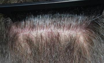 Surgical hair transplantation result photographs