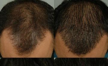 Hair restoration procedure before and after results