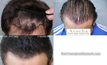 Hair transplantation surgery before and after photos