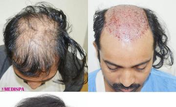 Top view - Before and after hair restoration procedure