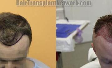 Hair restoration procedure before and after results